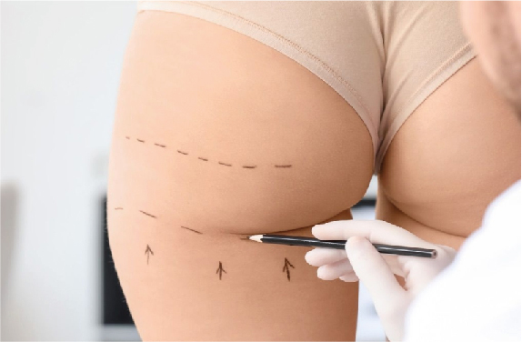 Ácido Hialurónico en Glúteos